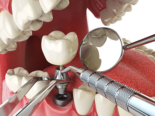Best Lost Filling or Crown Replacement in Central Gardens, TX
